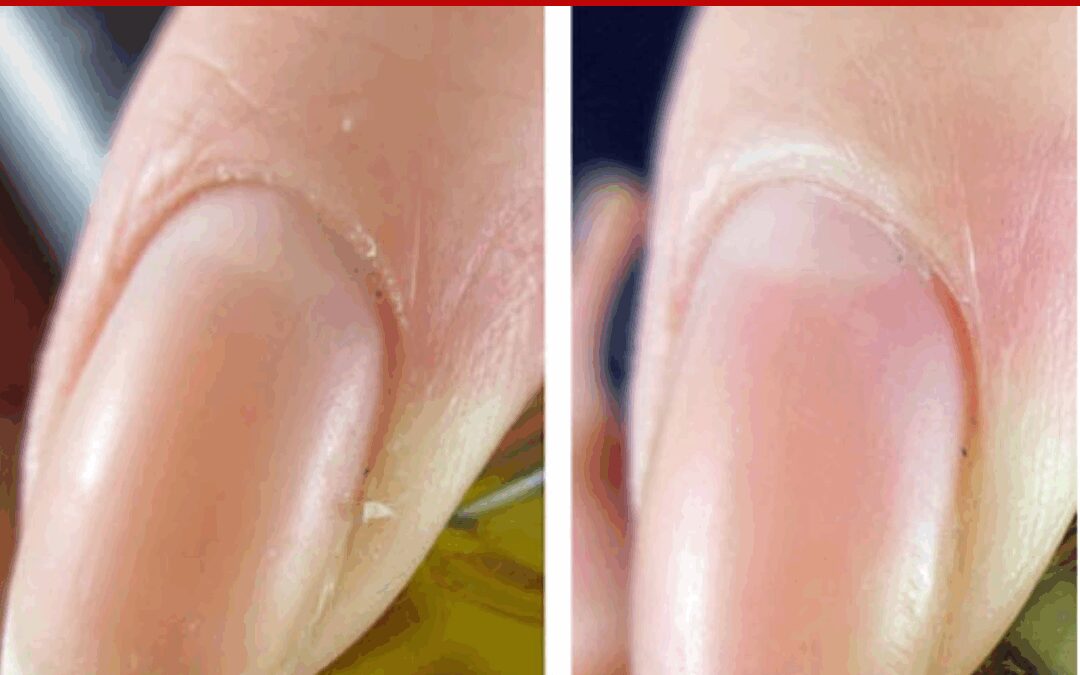 TREATMENT OF DRY SKIN – Ana Explains Kira’s Results