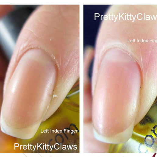 TREATMENT OF DRY SKIN – Pure Nail Oil™ Challenger Kira’s Results
