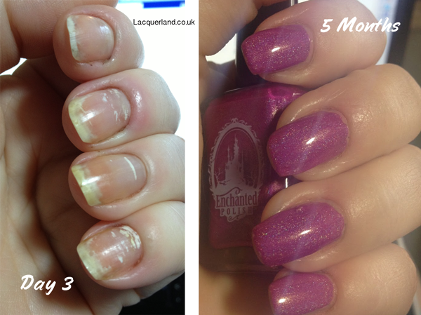 WHITE SPOTS IN NAILS – Sue’s Pure Nail Oil™ Challenge