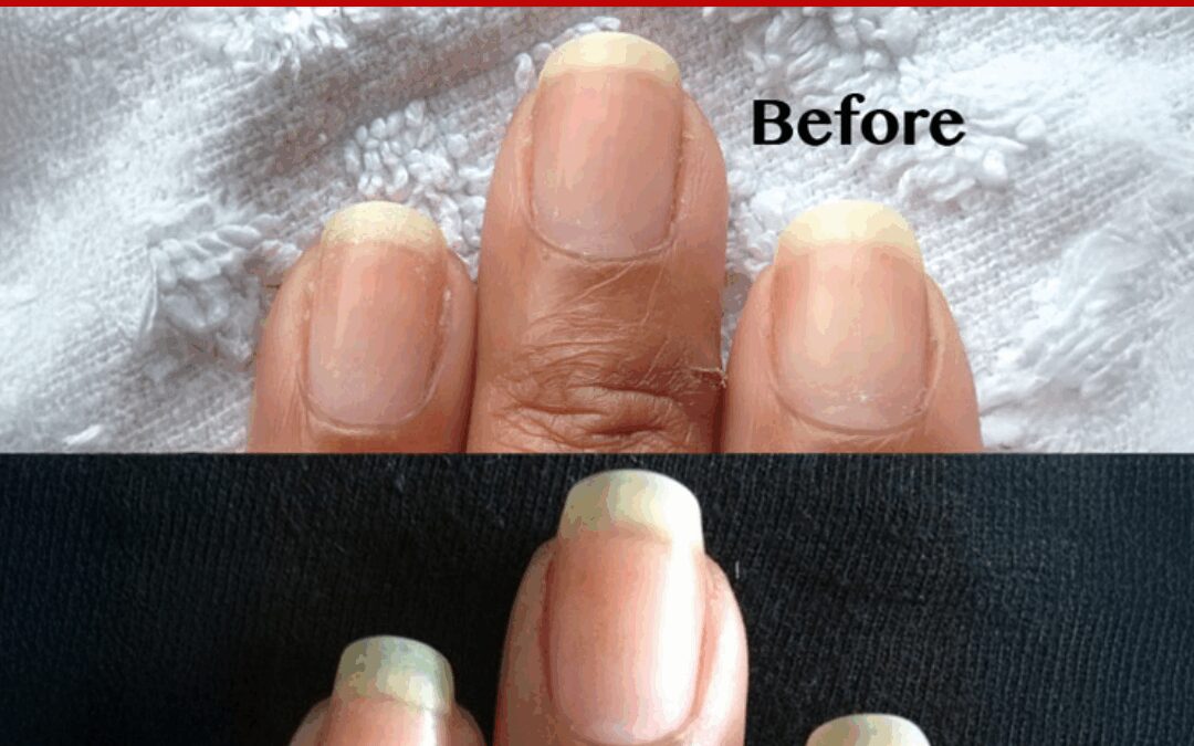 PEELING NAILS – Becky’s Pure Nail Oil™ Results