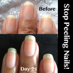 Peeling-nails-Becky-Before-Closeup www.NailCareHQ.com