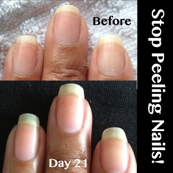 PEELING NAILS – Becky’s Pure Nail Oil™ Results