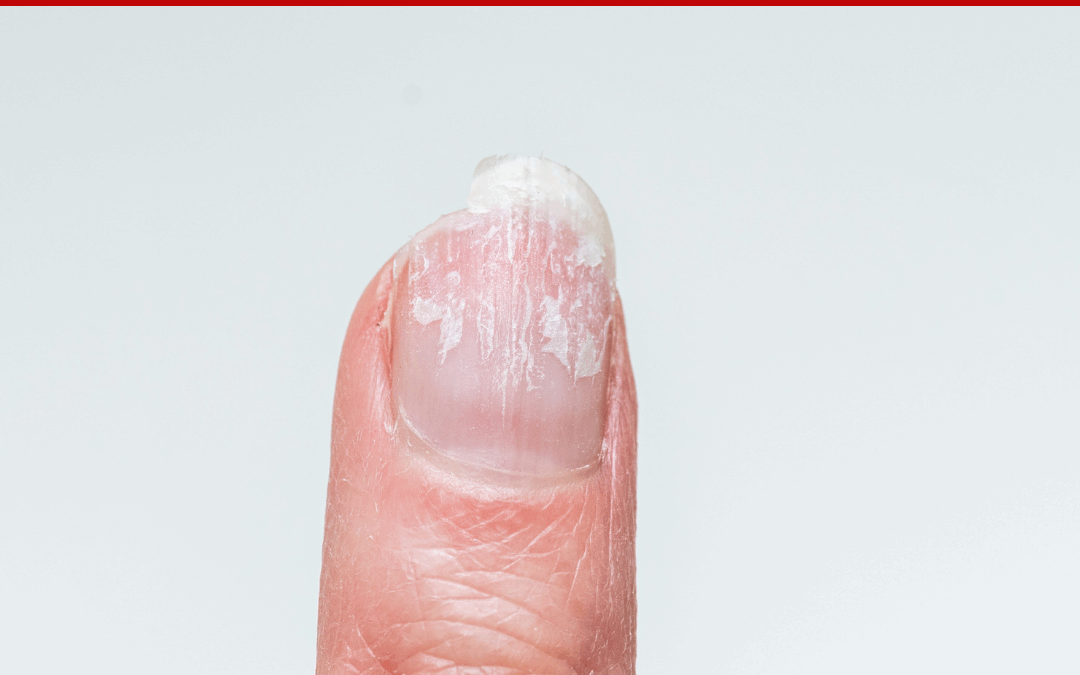 PEELING NAILS – Marie Claire’s Pure Nail Oil™ Results