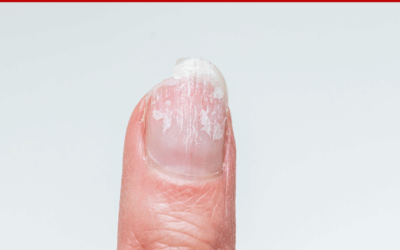 PEELING NAILS – Marie Claire’s Pure Nail Oil™ Results