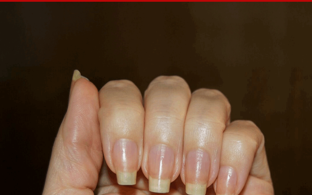 See Through Nails – Can I Fix It?