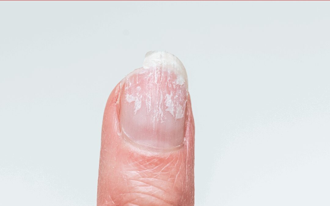 ASK ANA: Peeling Nails – Does Polish Prevent It?