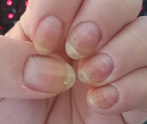 black spots in nails nailcarehq