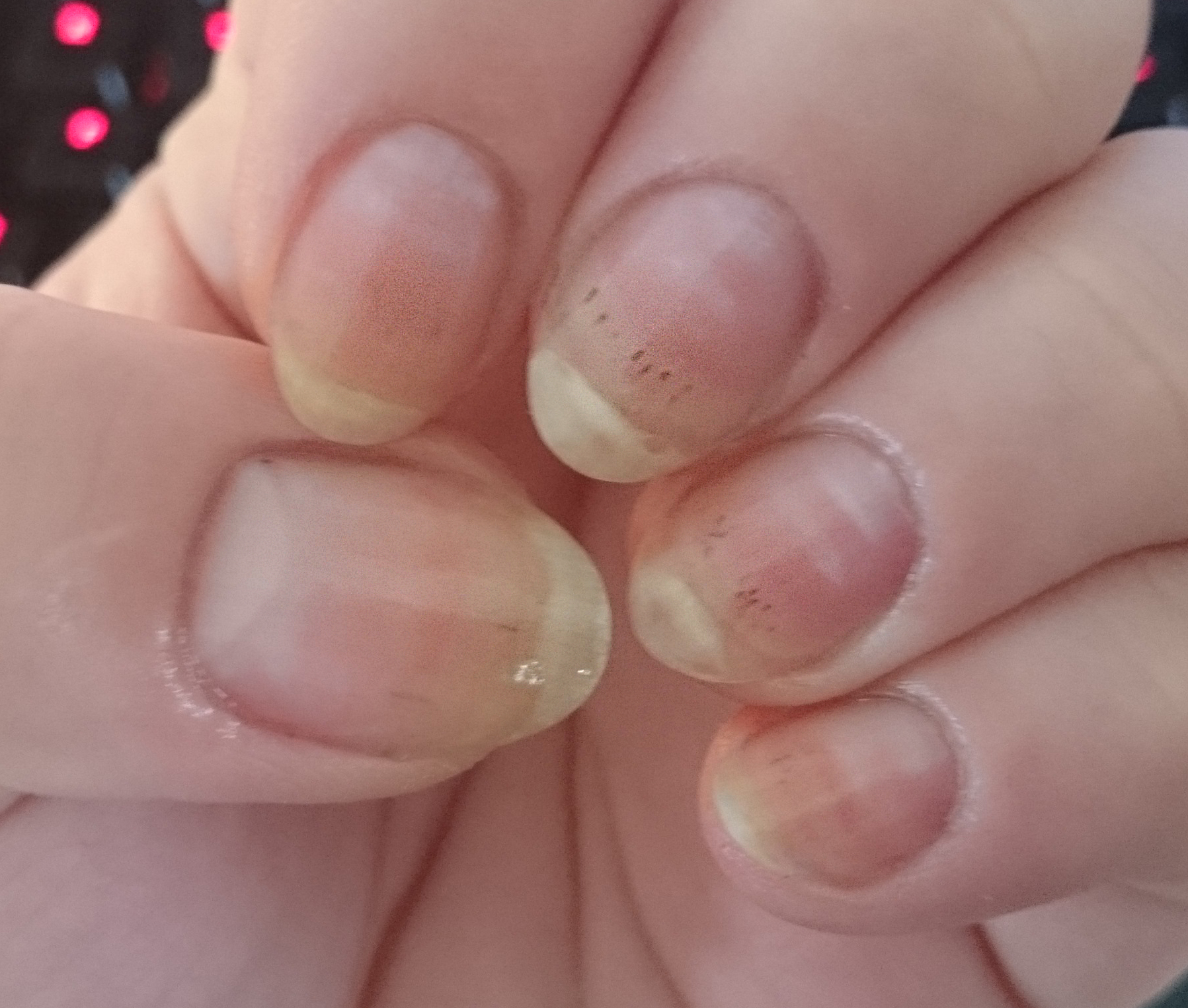 Close-up of hand showing dark splinter hemorrhage streaks under fingernails