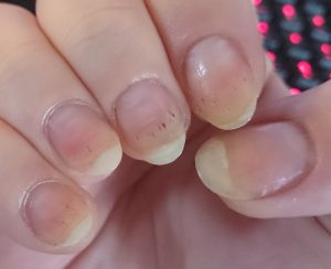 black spots in nails nailcarehq