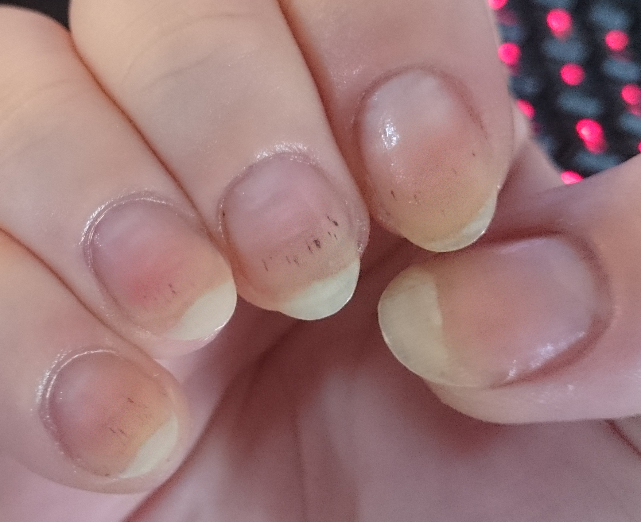 Right hand showing multiple nails with splinter hemorrhage dark spots