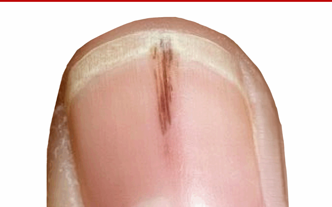 ASK ANA: Black Spots In Nails