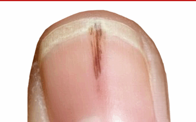 ASK ANA: Black Spots In Nails