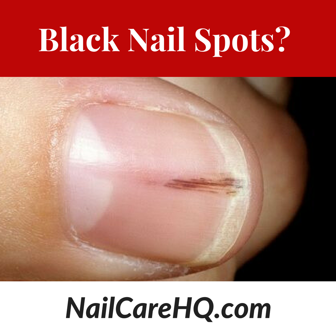 ASK ANA: Black Spots In Nails