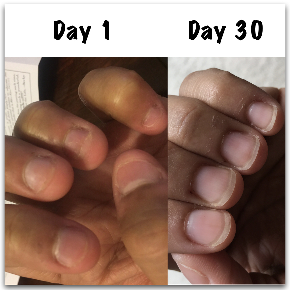 How to stop biting nails - Angela's nail oil results