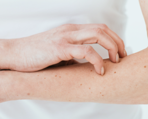 Photo of nails scratching an itch on  woman's arm. Scratching can lead to peeling nails because of tip wear.