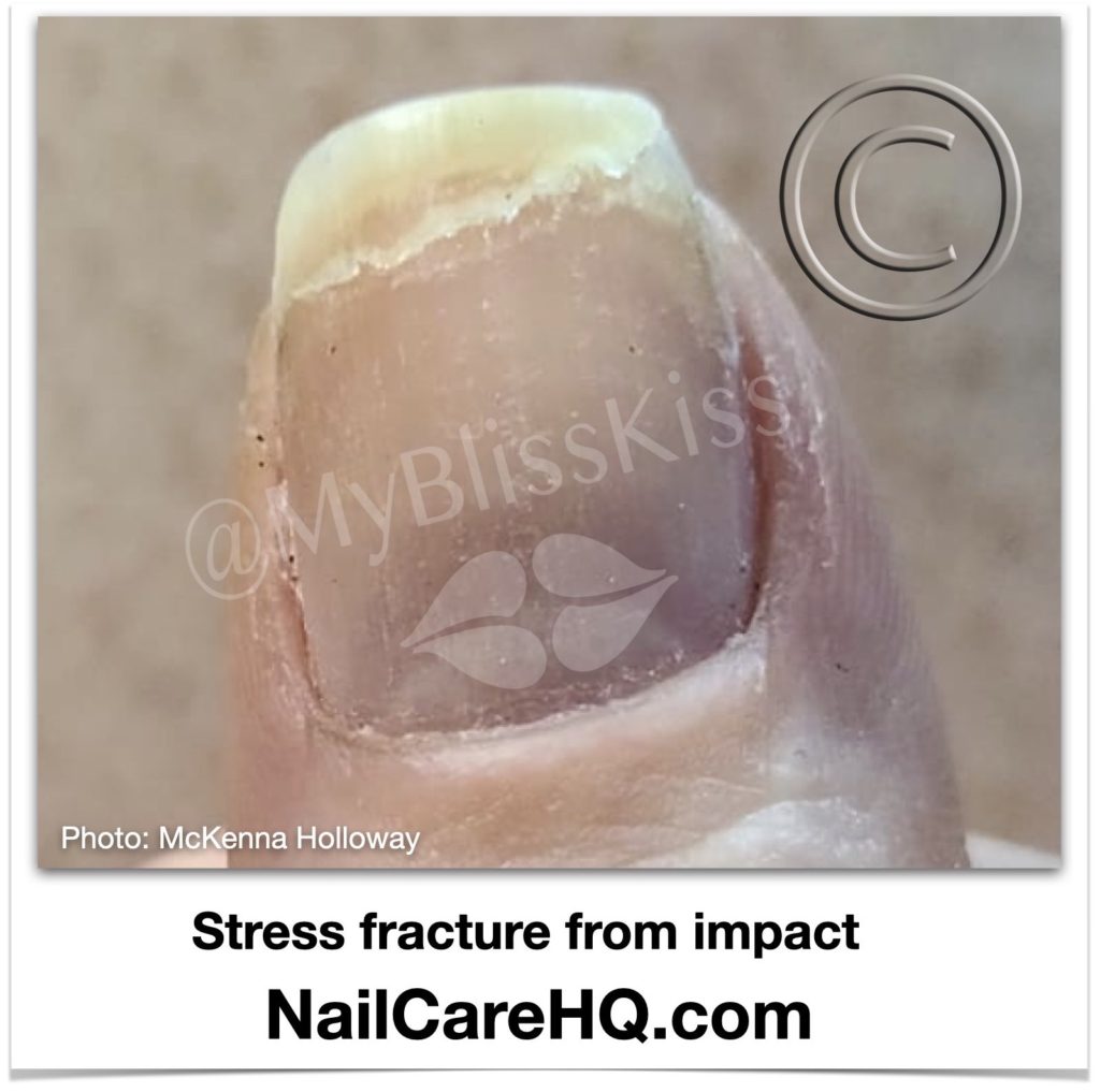 Photo of a nail stress fracture from impact with a hard object. These types of fractures are the major cause of nail peeling. Nailcarehq.com