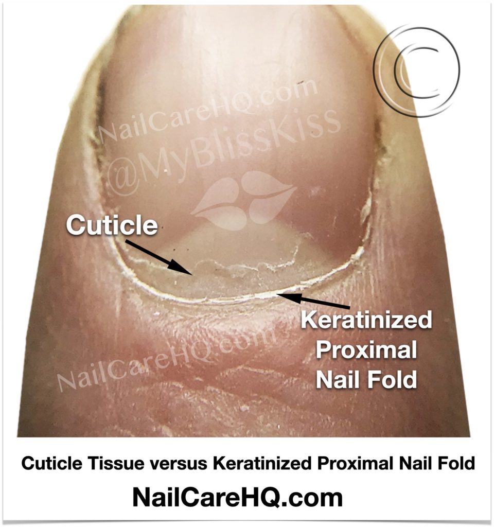 Image of human fingertip with indicators of the proper location of the cuticle and the keratinized proximal nail fold. Copyright Nailcarehq.com