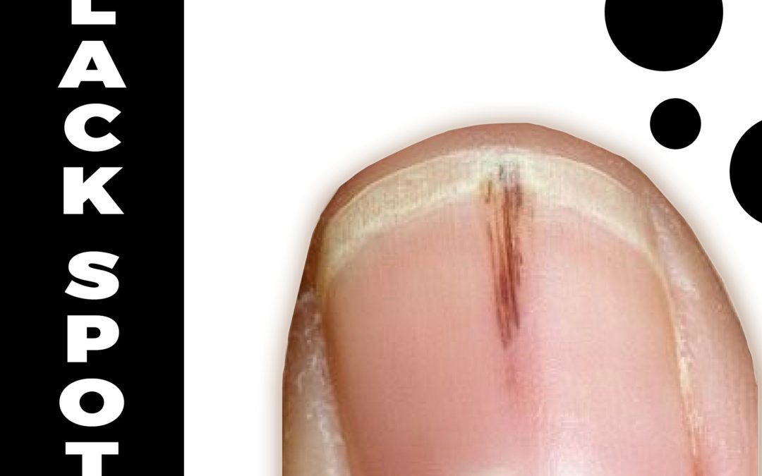 Quick Tips: What are black spots on nails?